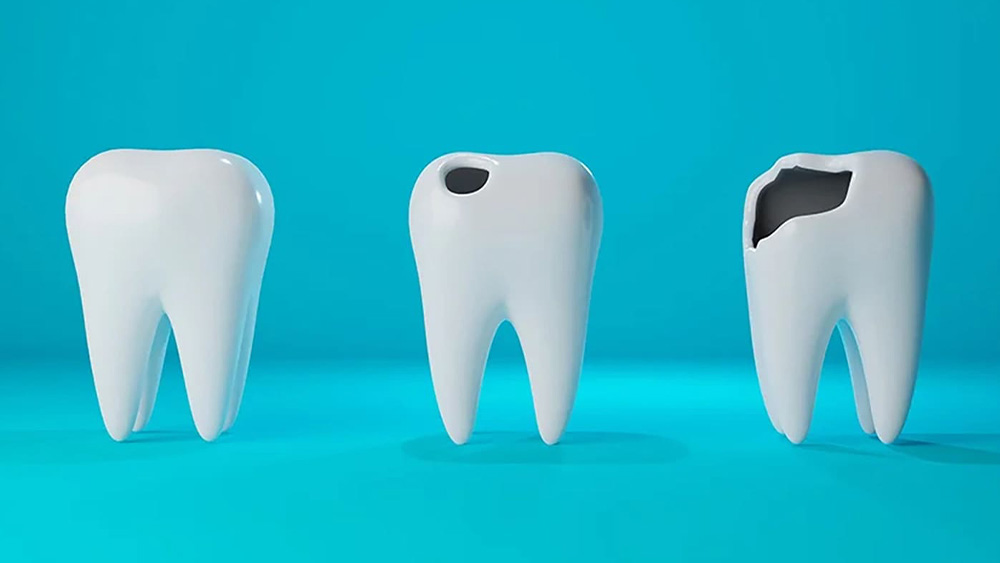 むし歯治療とは