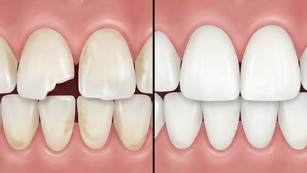 ダイレクトボンディング