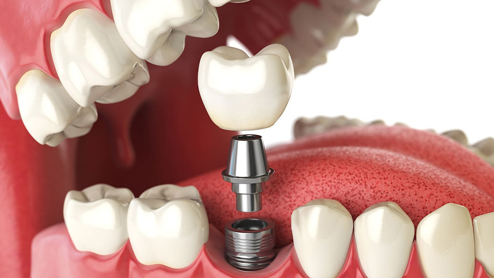 インプラント治療とは