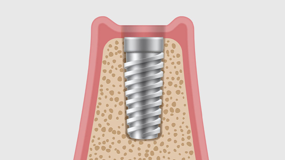 インプラント埋入手術