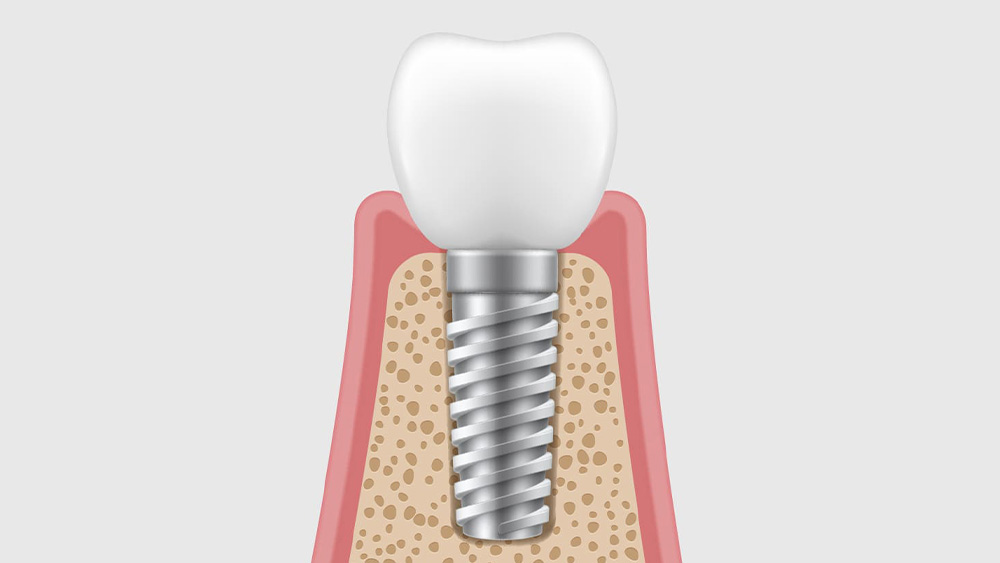 上部構造の装着