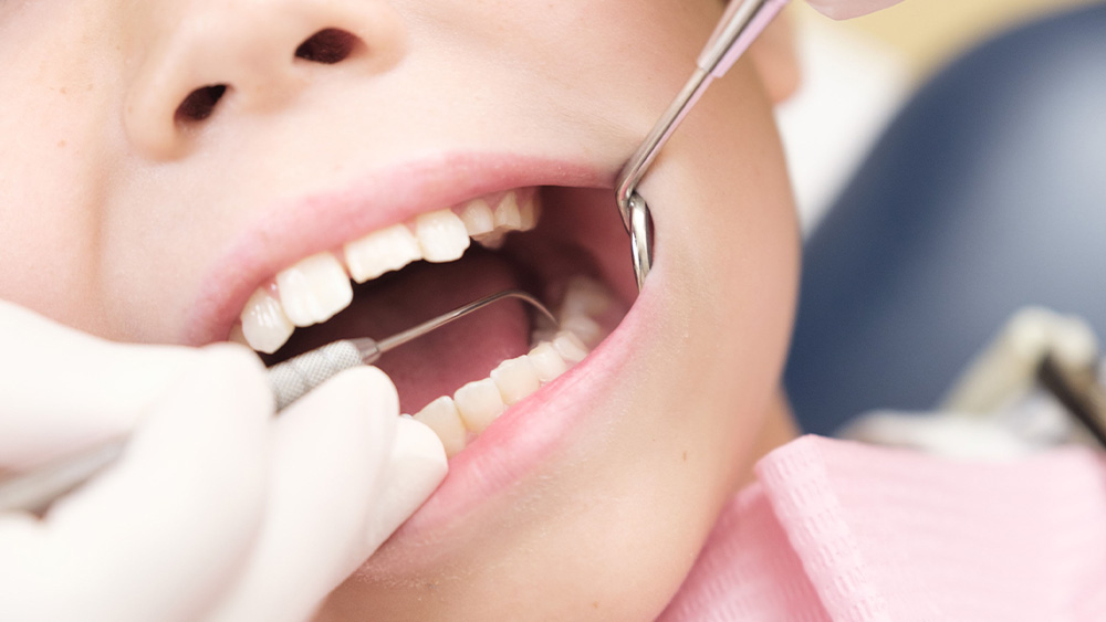 乳歯のむし歯治療