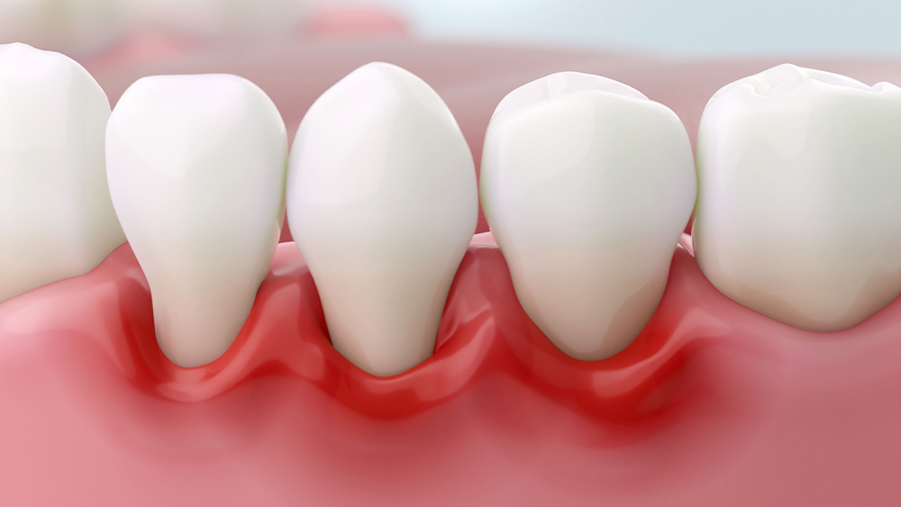 歯周病治療とは