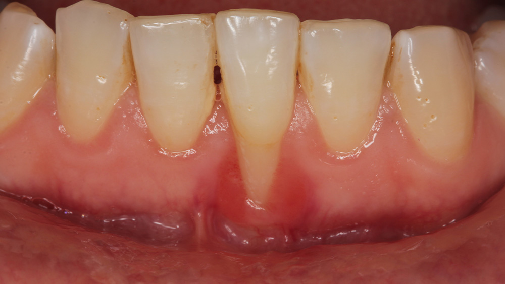 歯周組織再生療法