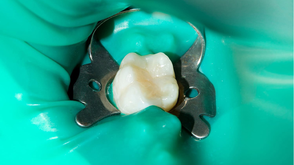 細菌感染から歯を守るための丁寧な処置