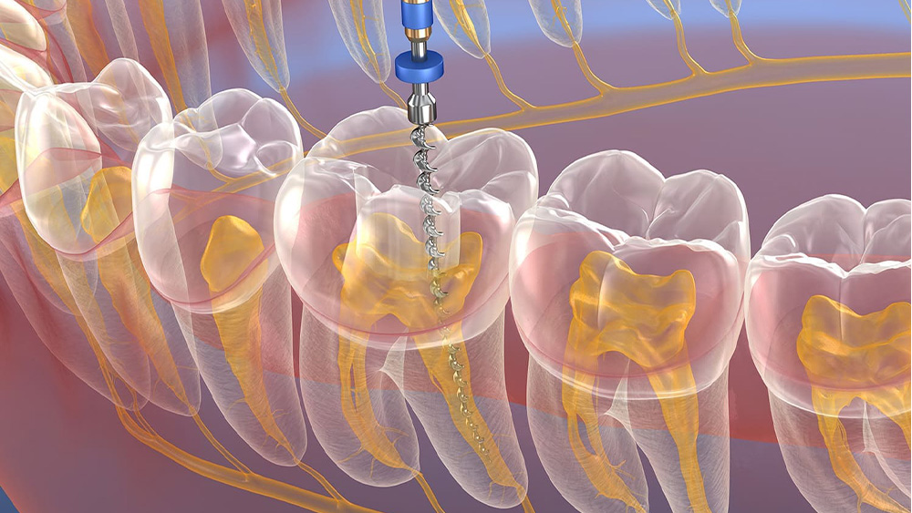 感染した神経の治療