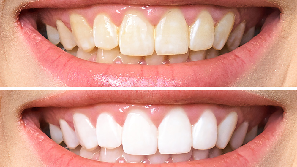 ホワイトニングとは